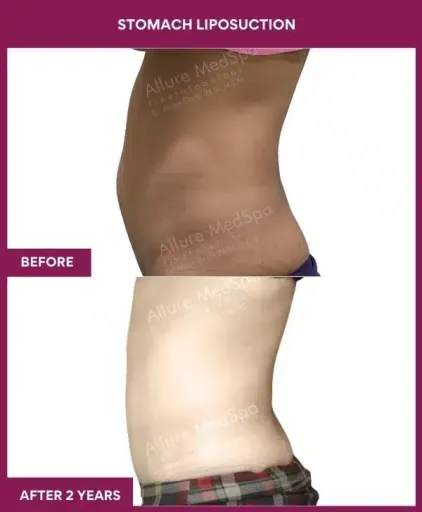 5- Stomach Liposuction--