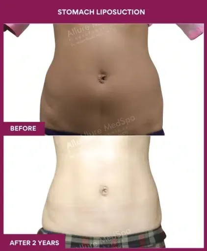 5- Stomach Liposuction