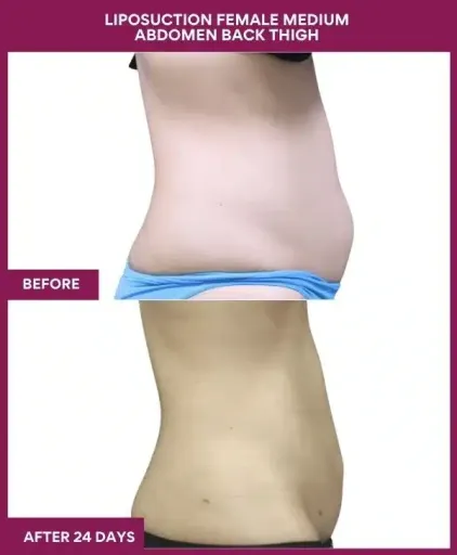 7-LIPOSUCTION FEMALE MEDIUM ABDOMEN BACK THIGH-