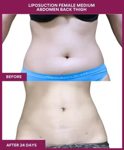 7- LIPOSUCTION FEMALE MEDIUM ABDOMEN BACK THIGH