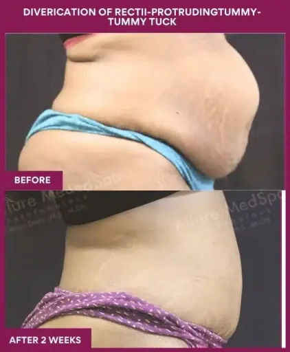 8 DIVERICATION OF RECTII-PROTRUDINGTUMMY- TUMMY TUCK_6_ (4)