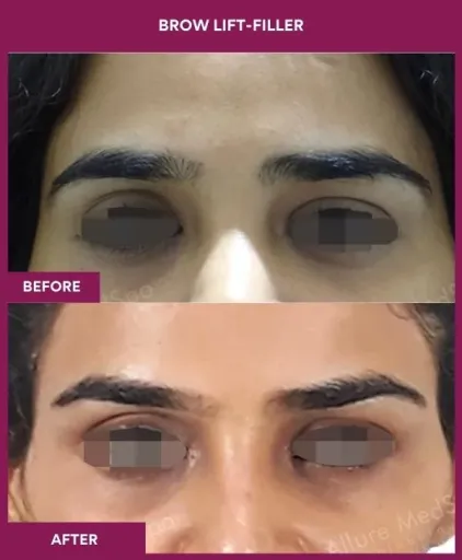 1 BROW LIFT-ENDOSCOPIC (1)_1