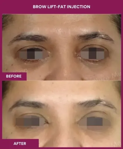 1 BROW LIFT-ENDOSCOPIC (2)_1