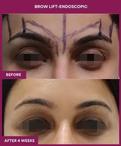 1 BROW LIFT-ENDOSCOPIC (3)_1