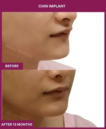 12 Chin Implant (2)_33_