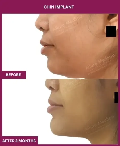13 Chin Implant (3)_36