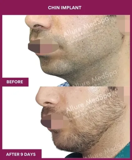 15 Chin Implant_43_ (2)