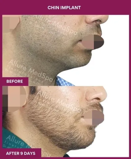 15 Chin Implant_43_ (3)