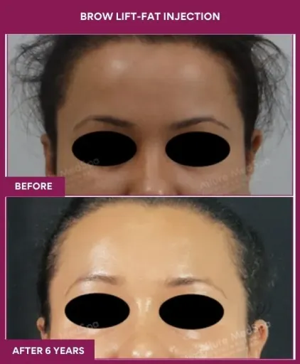 4 BROW LIFT-ENDOSCOPIC_12_