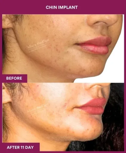 8 Chin Implant (5)_23_