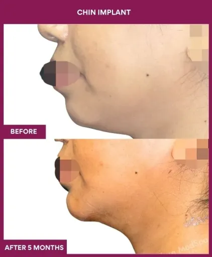 9 Chin Implant (3)_26_
