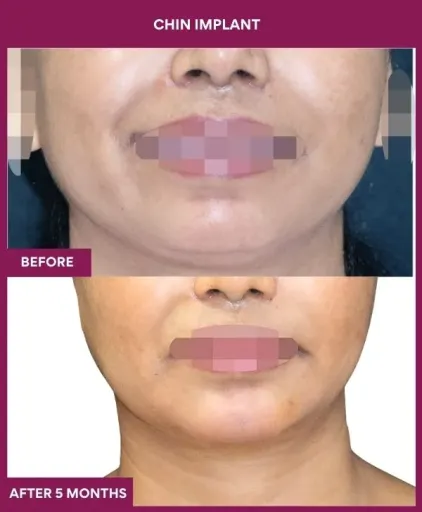 9 Chin Implant (4)_26_