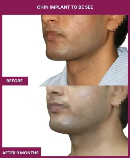 chin implant surgery in mumbai