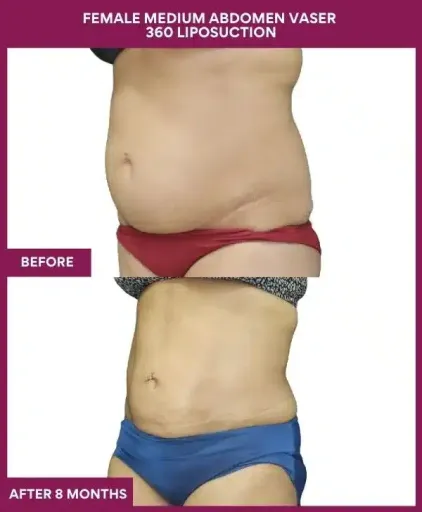 FEMALE MEDIUM ABDOMEN VASER 360 LIPOSUCTION in Mumbai, India