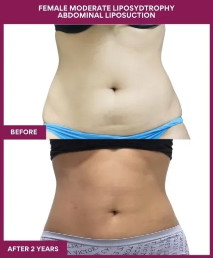 FEMALE MODERATE LIPOSYDTROPHY ABDOMINAL LIPOSUCTION in Mumbai, India