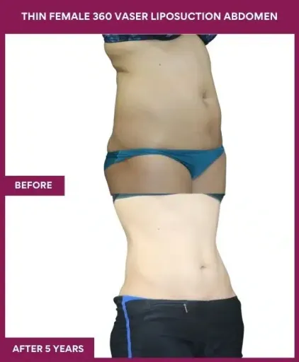 THIN FEMALE 360 VASER LIPOSUCTION ABDOMEN (3)_96_