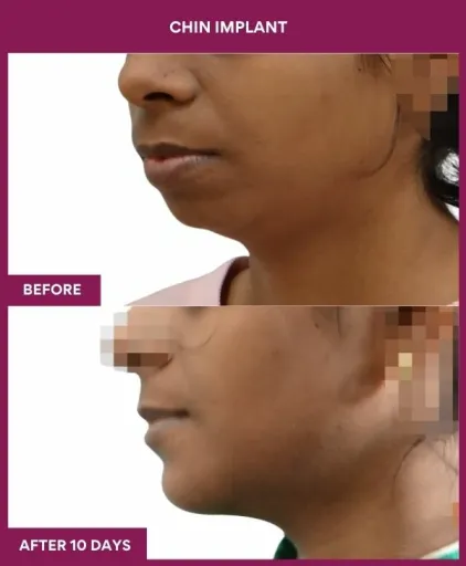 1 Chin Implant (2)