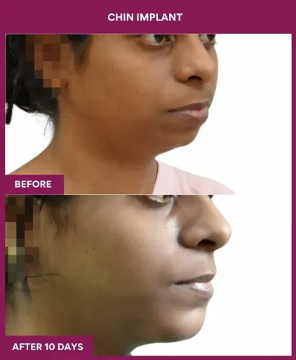 1 Chin Implant (3)