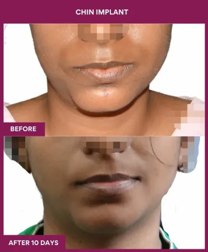 1 Chin Implant