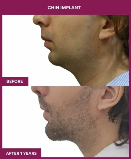11 Chin Implant (2)