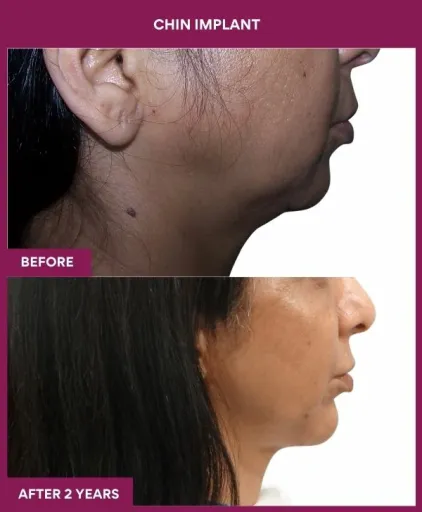 2 Chin Implant (2)