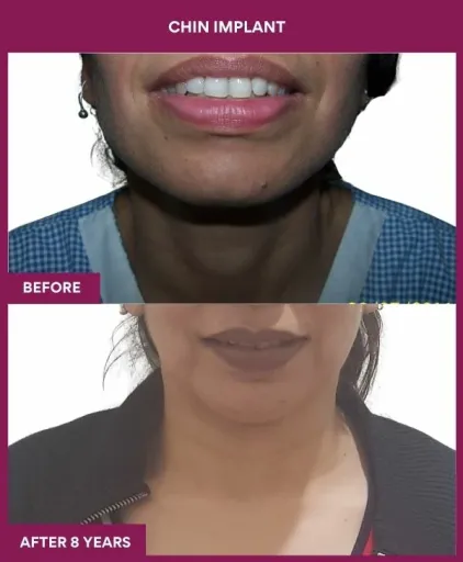 3 Chin Implant