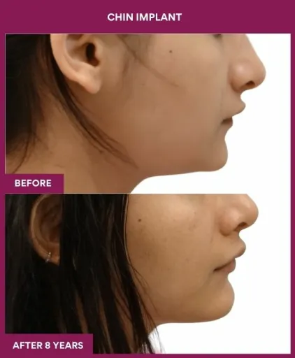 4 Chin Implant (2)