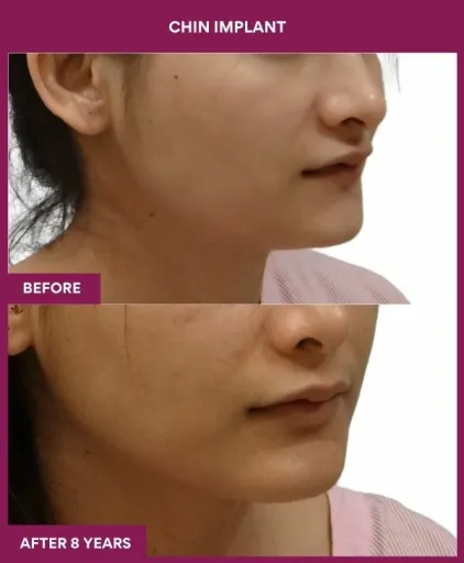 4 Chin Implant (3)