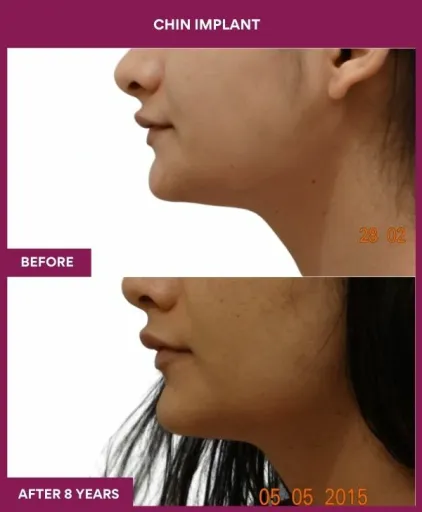4 Chin Implant