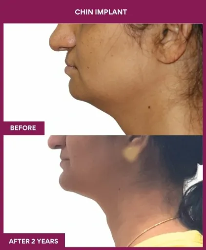 6 Chin Implant (2)