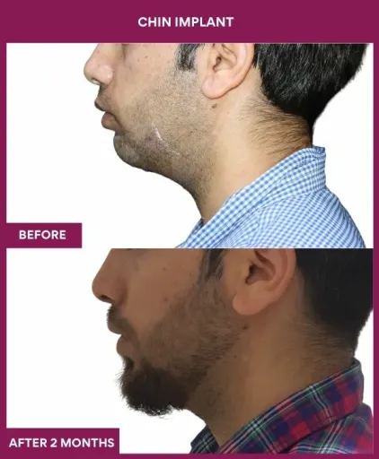 7 Chin Implant (2)