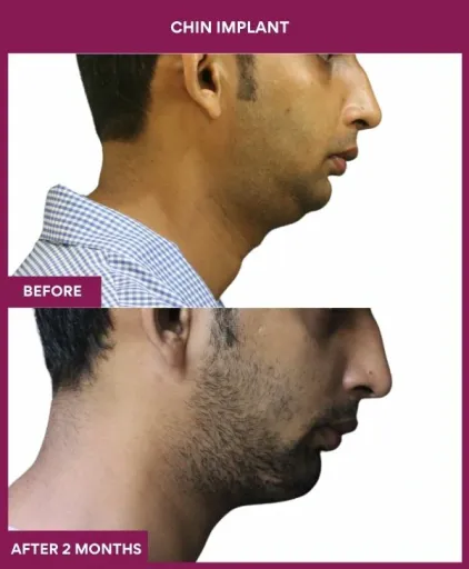 8 Chin Implant (3)