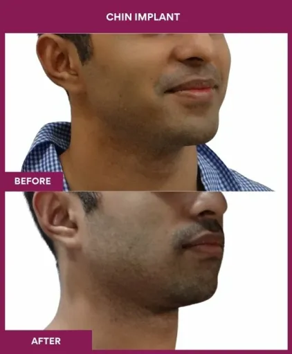 9 Chin Implant (2)