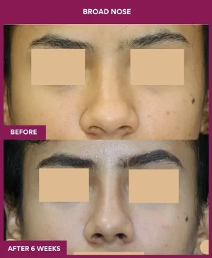 4 BROAD NOSE_12_ (1)