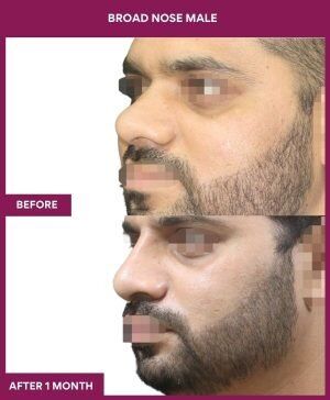 BROAD NOSE MALE Surgery In Mumbai, India