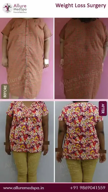 Bariatric-Surgery-Before-and-After-Images-in-Mumbai-India