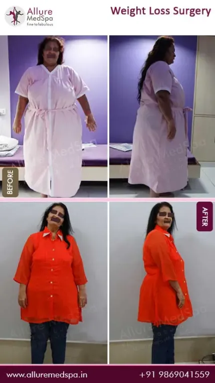 Bariatric-Surgery-Before-and-After-Result-in-Mumbai-India