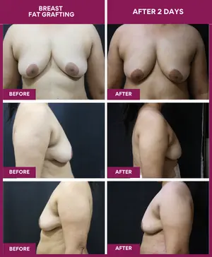 Breast-fat-grafting-surgery-result-before-after-image