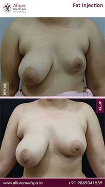 Fat-Injection-Before-and-After-Images