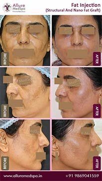 Fat-Transfer-Before-and-After-Result