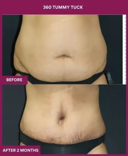 Tummy Tuck Surgery 18 10 360 tummy tuck_30_ (1)