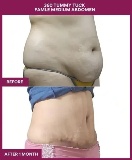 Tummy Tuck Surgery 22 11 360 TUMMY TUCK FAMLE MEDIUM ABDOMEN_33_ (2)