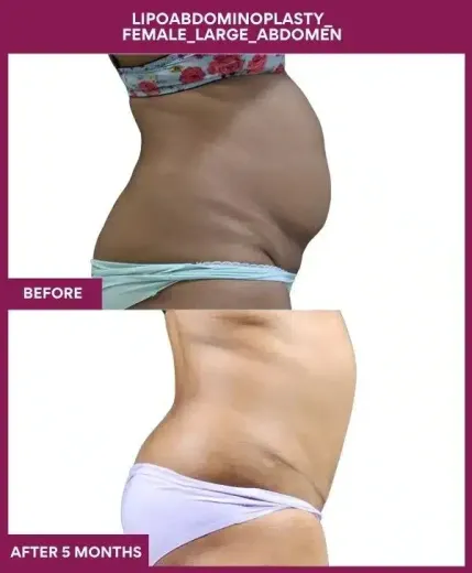 Tummy Tuck Surgery 25 12 Lipoabdominoplasty_ Female_Large_Abdomen_36_ (3)