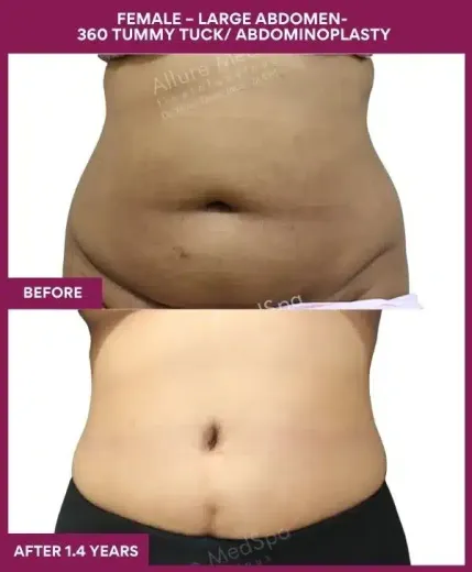 Tummy Tuck Surgery 27 13 FEMALE – LARGE ABDOMEN- 360 TUMMY TUCK_ ABDOMINOPLASTY_39
