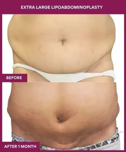 Tummy Tuck Surgery 6 2 EXTRA LARGE LIPOABDOMINOPLASTY_6_ (1)