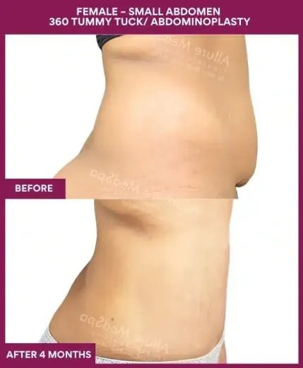 Tummy Tuck Surgery 10 3 FEMALE – SMALL ABDOMEN 360 TUMMY TUCK_ ABDOMINOPLASTY (2)_7