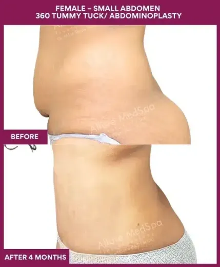 Tummy Tuck Surgery 8 3 FEMALE – SMALL ABDOMEN 360 TUMMY TUCK_ ABDOMINOPLASTY (3)_8