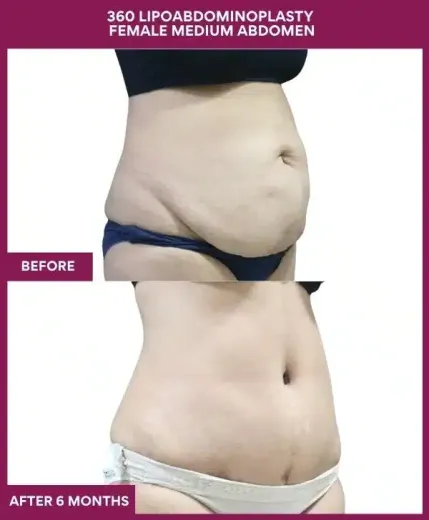 Tummy Tuck Surgery 16 9 360 LIPOABDOMINOPLASTY FEMALE MEDIUM ABDOMEN (2)_25_11zon