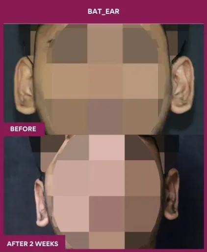 Ear Correction Surgery 5 Otoplasty Surgery in Mumbai