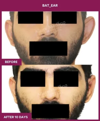 Ear Correction Surgery 2 Ear Correction Surgery in Mumbai, India